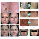 Shape Tactics - Láser de picosegundos de precisión: eliminación de tatuajes y renovación de la piel