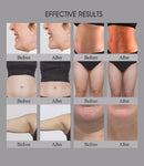 Shape Tactics: dispositivo inteligente de modelado corporal por radiofrecuencia