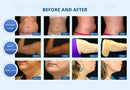 Máquina de adelgazamiento por vacío con criolipólisis y eliminación de papada Shape Tactics