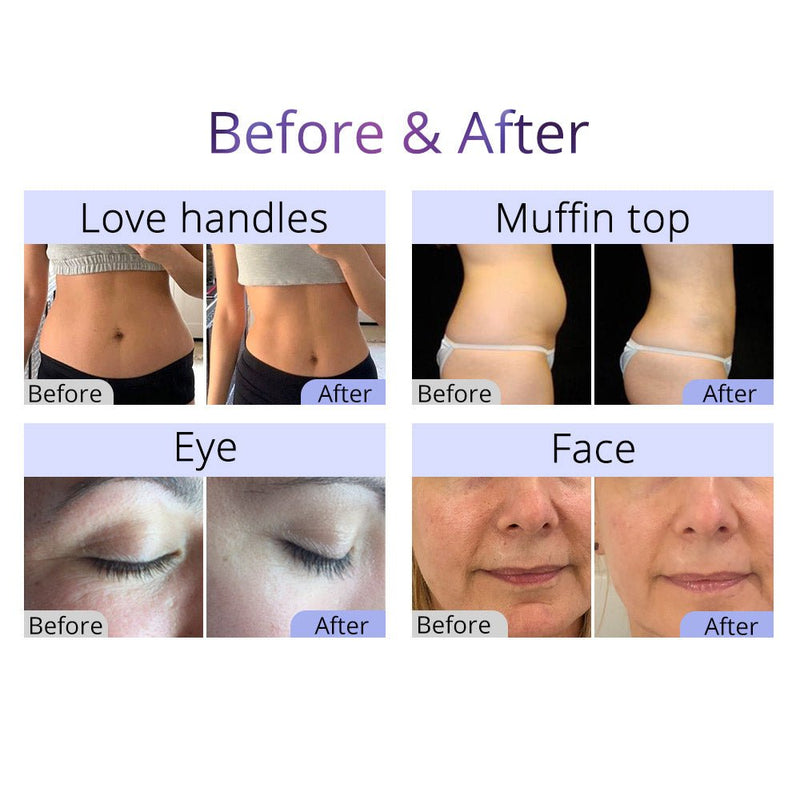 Aristorm 40K Cavitation 2.5 RF Skin Scrubber & Blackhead Removal Facial Machine