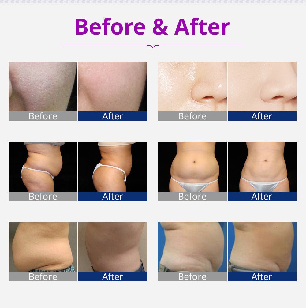 Kim 8 - K10 6-in-1 Lipo Laser Cavitation RF Body Slimming