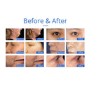 Máquina de cavitación ultrasónica RF para adelgazar Shape Tactics 5 en 1 Unoisetion 