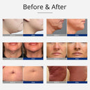 Dispositivo de cavitación RF con martillo frío/calor 8 en 1 Shape Tactics