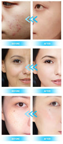 Dermoabrasión hidroeléctrica avanzada 14 en 1 con terapia de luz PDT de Shape Tactics