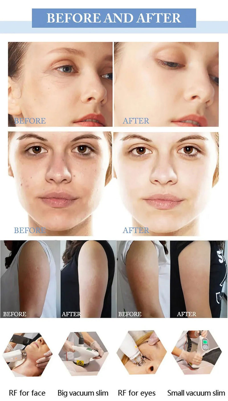 Shape Tactics Advanced Body Sculpting Negative Pressure and Inner Ball Roller Technology