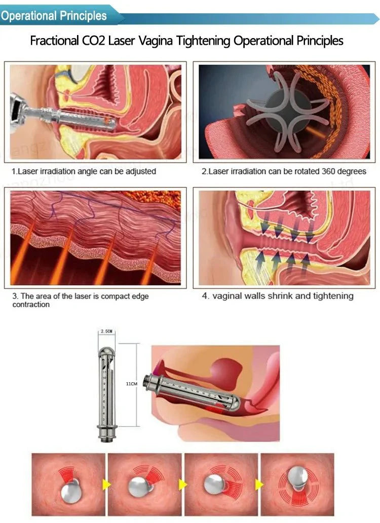 Shape Tactics CO2 Dot Laser Microvascular Reconstruction Therapy Device