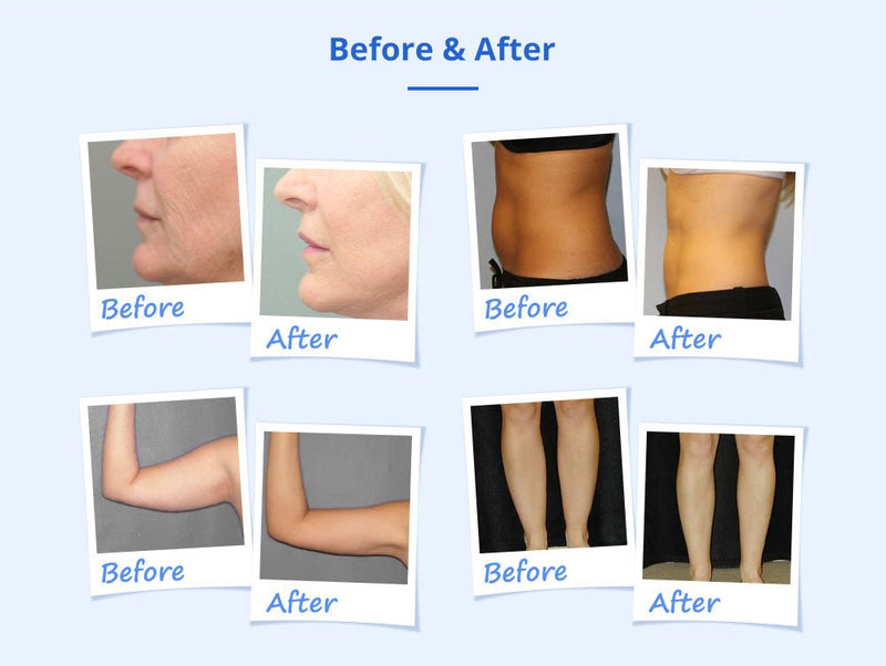 Shape Tactics - Cryolipolysis 40K Cavitation RF Body Contouring System
