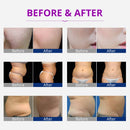 Shape Tactics Portable 5-in-1 40K Cavitation Body Contouring System