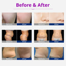 Máquina de adelgazamiento por radiofrecuencia con cavitación liposucción 40K portátil 6 en 1 Shape Tactics