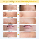 Shape Tactics Portable Diamond Microdermabrasion Device